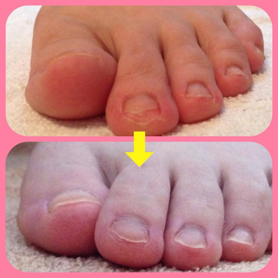 浮き指がどんどん良くなっています 町田市でo脚 外反母趾を改善する美脚専門サロン サロンニライ